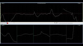 myotonic discharge [upl. by Arly]