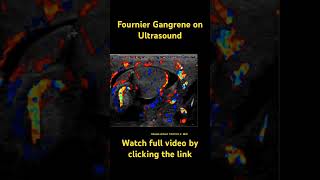 Fournier gangrene radiology radiologyresident medicine ultrasound dermatology [upl. by Elfreda]