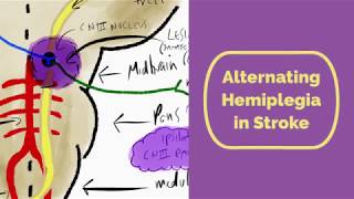 Alternating Hemiplegia in Stroke [upl. by Davilman]