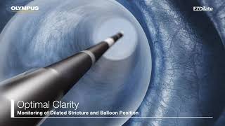 EZDilate MultiStage Balloon Dilator Animation Video [upl. by Gnanmos102]