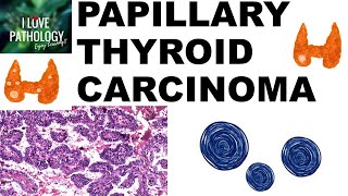 PAPILLARY THYROID CARCINOMA  Gross and Microscopic features [upl. by Aidul]