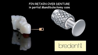 PIN RETAIN OVER DENTURE in Partial Mandibulectomy case [upl. by Kerman828]