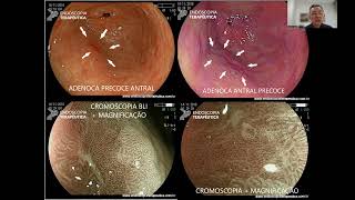 CANCER GASTRICO [upl. by Corinne]