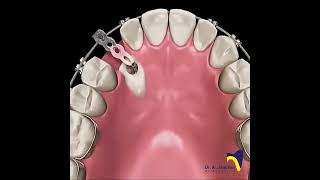 Canine Impaction dentistbracing orthodonticscanineimpactionImpactionExposureCanineexposure [upl. by Euqirrne79]