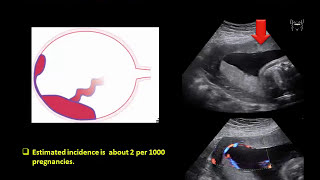 Ultrasound Imaging of the placenta Part 1 Anatomy and Variants [upl. by Lytsyrk]