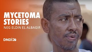 Mycetoma stories Neg Eldin El Albagir [upl. by Akirej717]