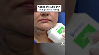 Doublechin removal using coolsculpting shorts [upl. by Bartholomew981]