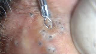 Blackheads Comedones  Behind extraction procedure [upl. by Ecineg697]