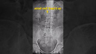 Kidney Stone Dikhai de raha hai [upl. by Vacuva]