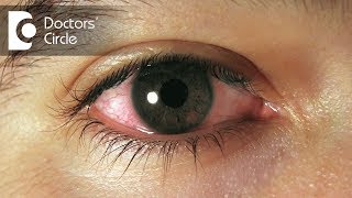 How to manage swollen amp sensitive eyes after injury  Dr Elankumaran P [upl. by Iives]