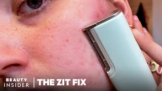 200 Dermaplaning Device Claims To Remove Flaky Skin And Peach Fuzz  The Zit Fix [upl. by Imer]