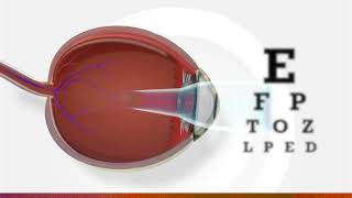 Peripheral hyperopic defocus and the cause of myopia progression explained [upl. by Herrle185]