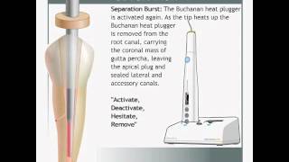 elementsfree Obturation System [upl. by Miculek528]