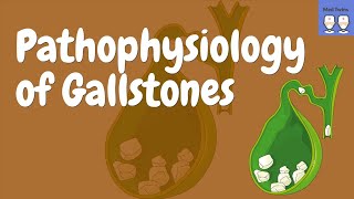 Gallstones Pathophysiology Cholecystitis Choledocholithiasis Diagnosis ComplicationsTreatment [upl. by Kono]