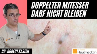 Doppelt endender Mitesser Darf nicht bleiben  Dr Kasten Hautmedizin in Mainz mitesser [upl. by Ecnesse]