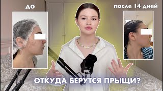 Ошибки в уходе за кожей  ПОЧЕМУ ПОЯВЛЯЮТСЯ ПРЫЩИ [upl. by Hazmah]