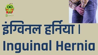 Inguinal Hernia  इंग्विनल हर्निया  Healthyho  Dr Satish Aggarwal [upl. by Drew947]