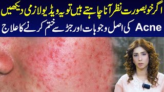 Understanding Acne Causes and Effective Treatments  Dr Sahar Chawla [upl. by Nylac93]