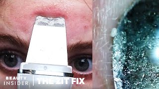 Pore Spatula Blackhead Extractions Under A Microscope  The Zit Fix [upl. by Itsirk]