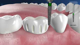 Metal ceramic restoration posterior teeth [upl. by Curran502]