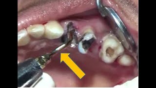 Piezo assisted grossly decayed maxillary teeth removal [upl. by Annairba822]