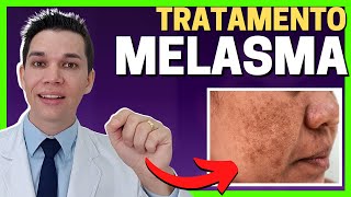 Como TRATAR MELASMA no Rosto Guia Definitivo [upl. by Dyan880]