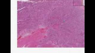 Histopathology AdrenalAdrenocortical carcinoma [upl. by Anitsrik94]