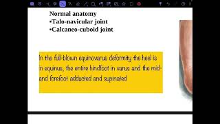 Congenital talipes equinovarus part 1 [upl. by Ahsiekram229]