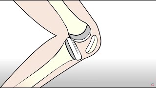 Knee Replacement vs Regenexx Orthopedic Regenerative Treatment [upl. by Phillada]