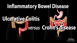 Ulcerative Colitis versus Crohns Disease Animation [upl. by Aralomo846]