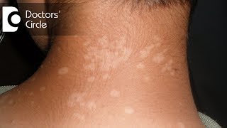 Pharmacological management of Tinea Versicolor in young individuals  Dr Urmila Nischal [upl. by Natsuj]