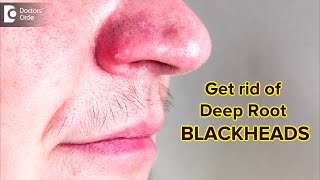 Get rid of BLACKHEADS the Right WayBlackheads locked deep in skinDrRajdeep MysoreDoctors Circle [upl. by Violet]