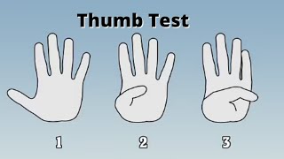 Thumb Test to Detect Aortic Aneurysm [upl. by Jaban98]