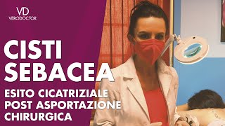 Cisti Sebacea analisi di un esito cicatriziale post asportazione chirurgica  VERODOCTOR [upl. by Ekud]