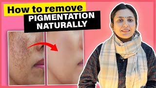 Natural Remedies for Pigmentation  Clear amp Glowing Skin  Upasana Ki Duniya [upl. by Nimocks]