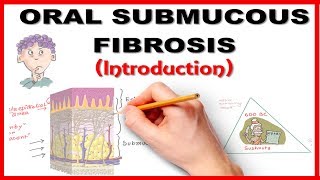 Oral Submucous Fibrosis OSMF Introduction [upl. by Hsilgne]