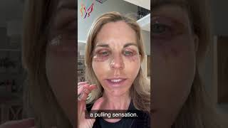 My Advanced Facelift Recovery Day by Day  Real Stories By Real Patients 2022 [upl. by Jyoti]