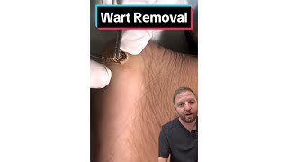 Wart Removal by Cauterizing Pain Free [upl. by Leipzig]