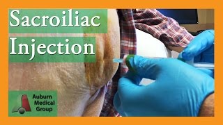 NEW SACROILIAC CORTISONE SHOT TECHNIQUE  Auburn Medical Group [upl. by Lovell]