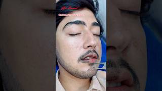 Carbon Peel Laser Treatment getsmarthairclub viralvideo beauty laserhairtreatment laser [upl. by Llecrep128]