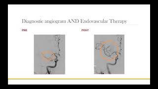 Crown preparation tutorial by Prof Brian Millar [upl. by Aguste]