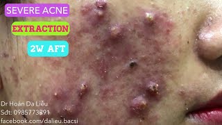 Mụn nhọt mủ siêu nặngSevere acnes pimplespusstuleblackheads before 2ws after and extraction [upl. by Ahsenik]