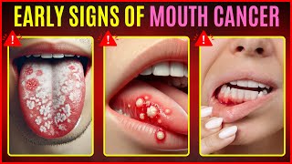 Symptoms of Oral Cancer  Early Warning Signs amp Prevention [upl. by Marienthal]