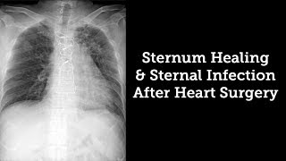 Sternum Healing amp Sternal Infection Rates After Heart Surgery with Dr Steve Bolling [upl. by Airdnazxela]