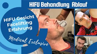 HIFU Behandlung Vorher Nachher Gesicht Erfahrung Ultraschall Lifting Gesichtstraffung ohne OP [upl. by Adrienne657]