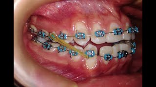 Elásticos Intermaxilares  Mira como ayudan en tu tratamiento con brackets☝ [upl. by Virnelli483]