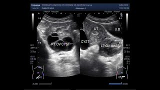 Ultrasound Video showing Two types of Ovarian Cysts and an Ovarian Mass [upl. by Lugo]