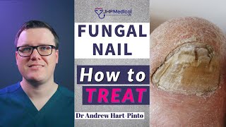 How to TREAT Fungal Nail  Get Rid Of Nail Fungus AntiFungal Lacquer amp Tablets [upl. by Nygem]