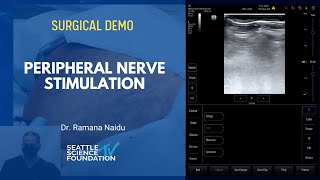 Peripheral Nerve Stimulation  Ramana Naidu MD [upl. by Aihcela]