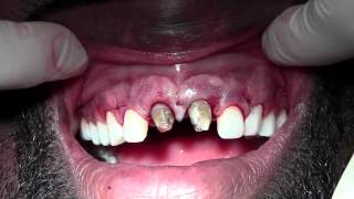 Clinical Crown Lengthening 611 Revision of Previous ST Gingivectomy [upl. by Sprague]